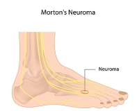 An Overview of Morton’s Neuroma