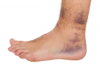 Ankle Sprains Defined by Symptoms