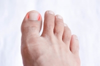 Symptoms and Treatments for an Ingrown Toenail