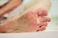 Plantar Warts: Common, Contagious, and Communal